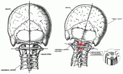 The Atlas Misalignment